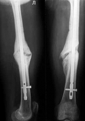 Сколько времени заживает кость. Сросшийся перелом бедренной кости рентген. Интрамедуллярный остеосинтез костная мозоль. Ложный сустав берцовой кости. Остеосинтез диафиза малоберцовой кости.